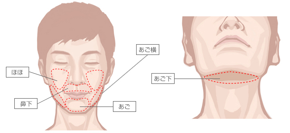 脱毛可能な部位