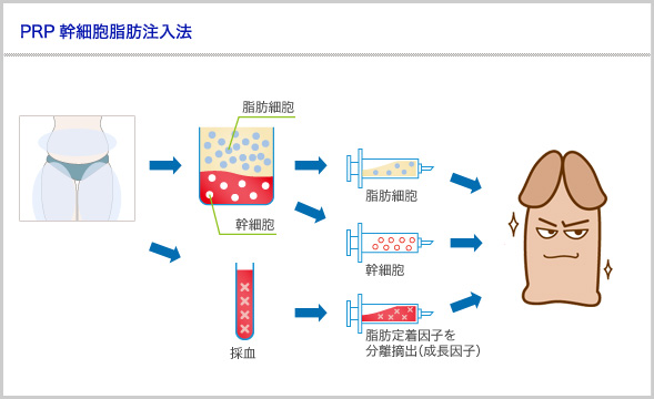 PRP幹細胞脂肪注入法