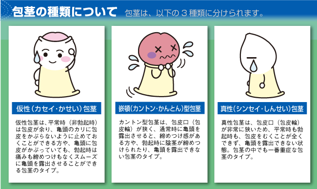 包茎の種類について