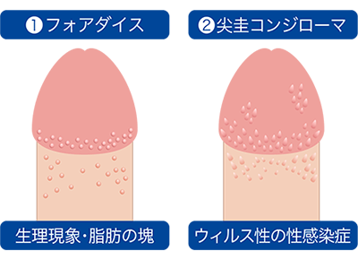 ペニスにできる「ブツブツ」の種類