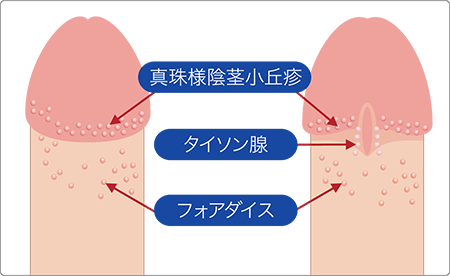 フォアダイスの症状