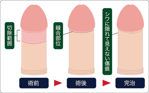 亀頭直下埋没法