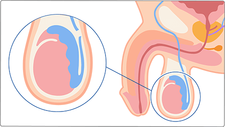 パイプカット手術の概要図