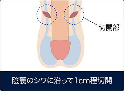 パイプカット手術の方法①