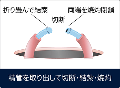 パイプカット手術の方法②